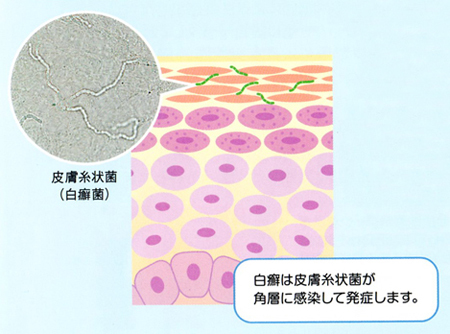真菌感染症 薬